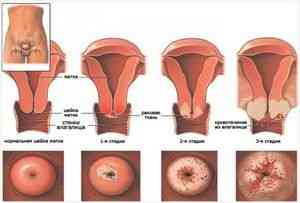 Рак шейки матки 3 стадии: способы лечения